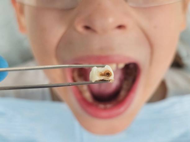 Best Broken or Cracked Tooth Emergency Dentist in Lake Placid, FL