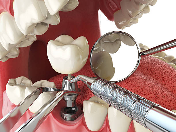 Best Emergency Dentist for Knocked-Out Tooth in Lake Placid, FL